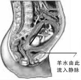 如何预防羊水栓塞